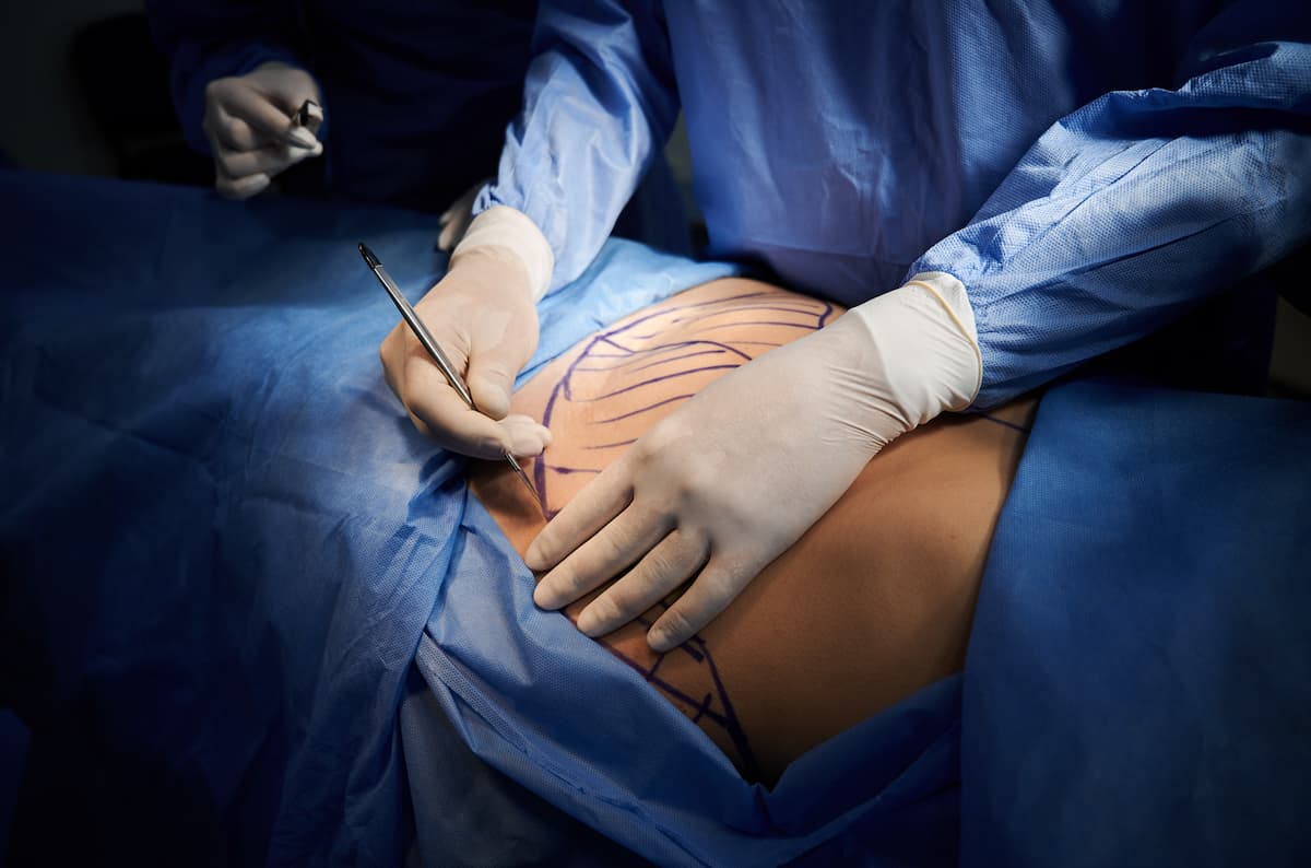 Lire la suite à propos de l’article Avis de personnes ayant subi une abdominoplastie